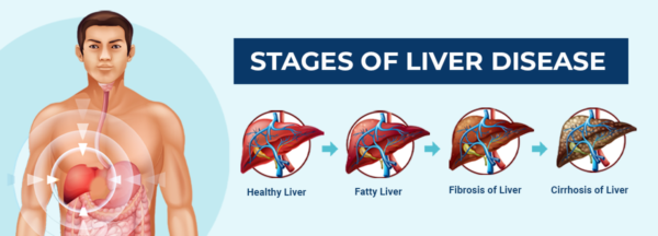 Liver test package | MyHealth Clinic